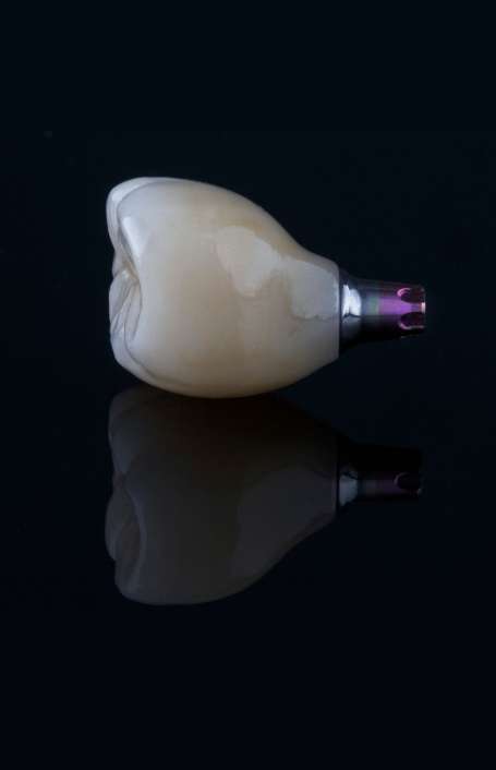 Dental implant Glenview IL