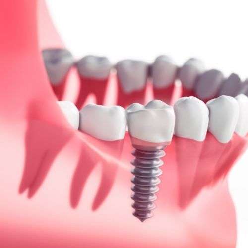 Dental implant glenview IL