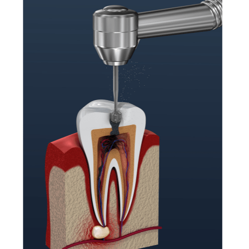 Root Canals glenview IL