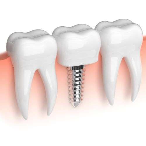 Bone graft - Dental implant Glenview IL