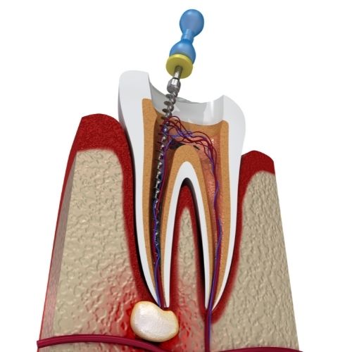 Root Canal Glenview IL
