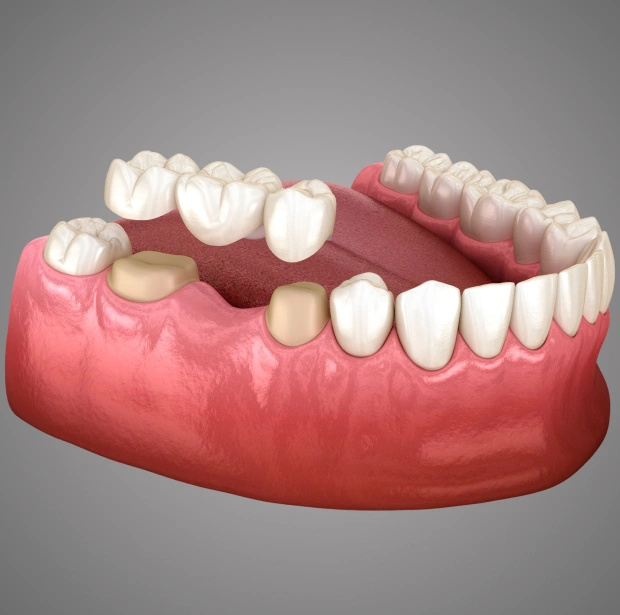 Dental Bridges