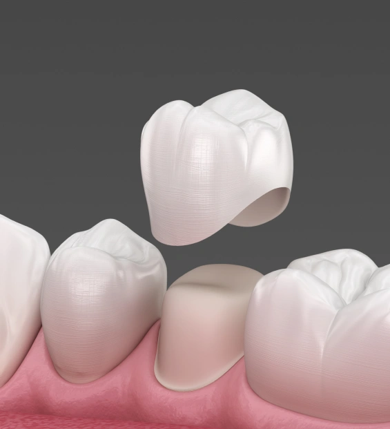 Dental Crowns
