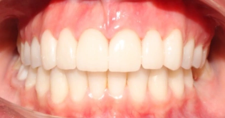 veneers-after-1