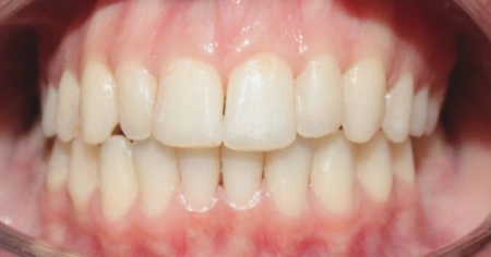 veneers-before-1