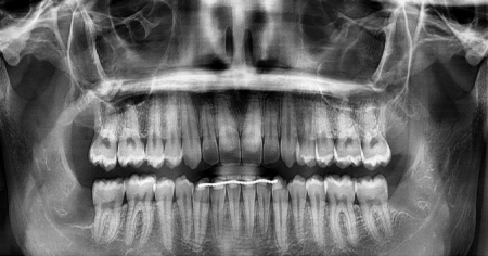 wisdom-teeth-after-1