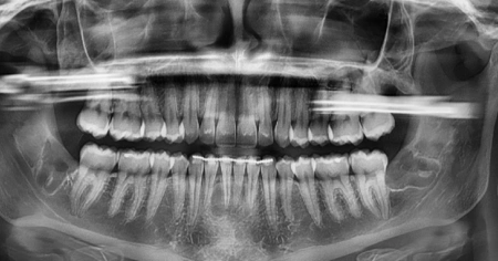 wisdom-teeth-after-3