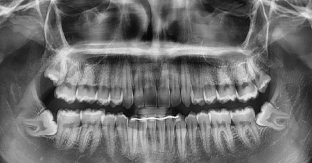 wisdom-teeth-before-1