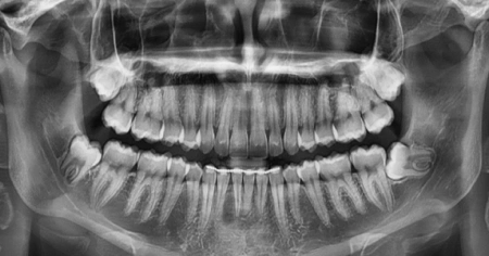 wisdom-teeth-before-2