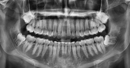 wisdom-teeth-before-3