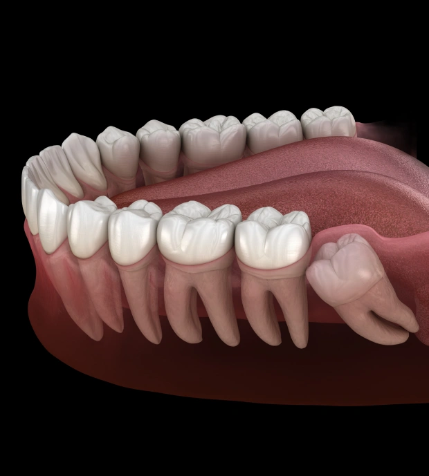 Wisdom Teeth Extraction