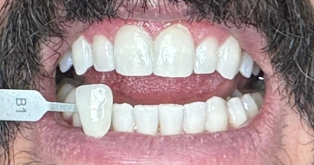 zoom-whitening-after-1
