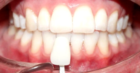 zoom-whitening-after-2