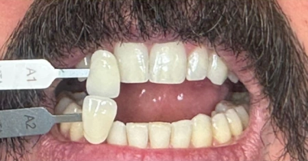 zoom-whitening-before-1