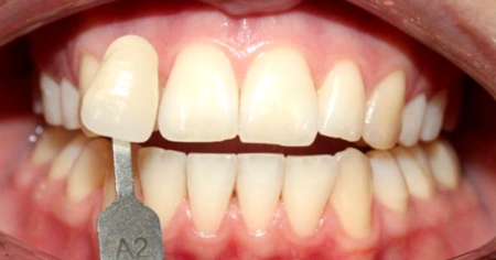 zoom-whitening-before-2